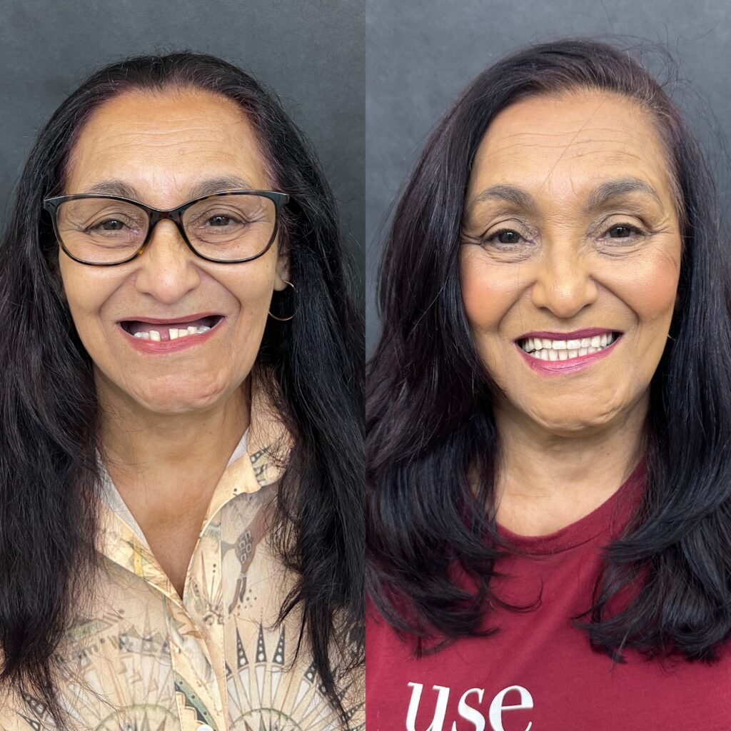 Antes e depois de paciente reabilitado com prótese protocolo sobre implantes na ImplanVita, em Belo Horizonte