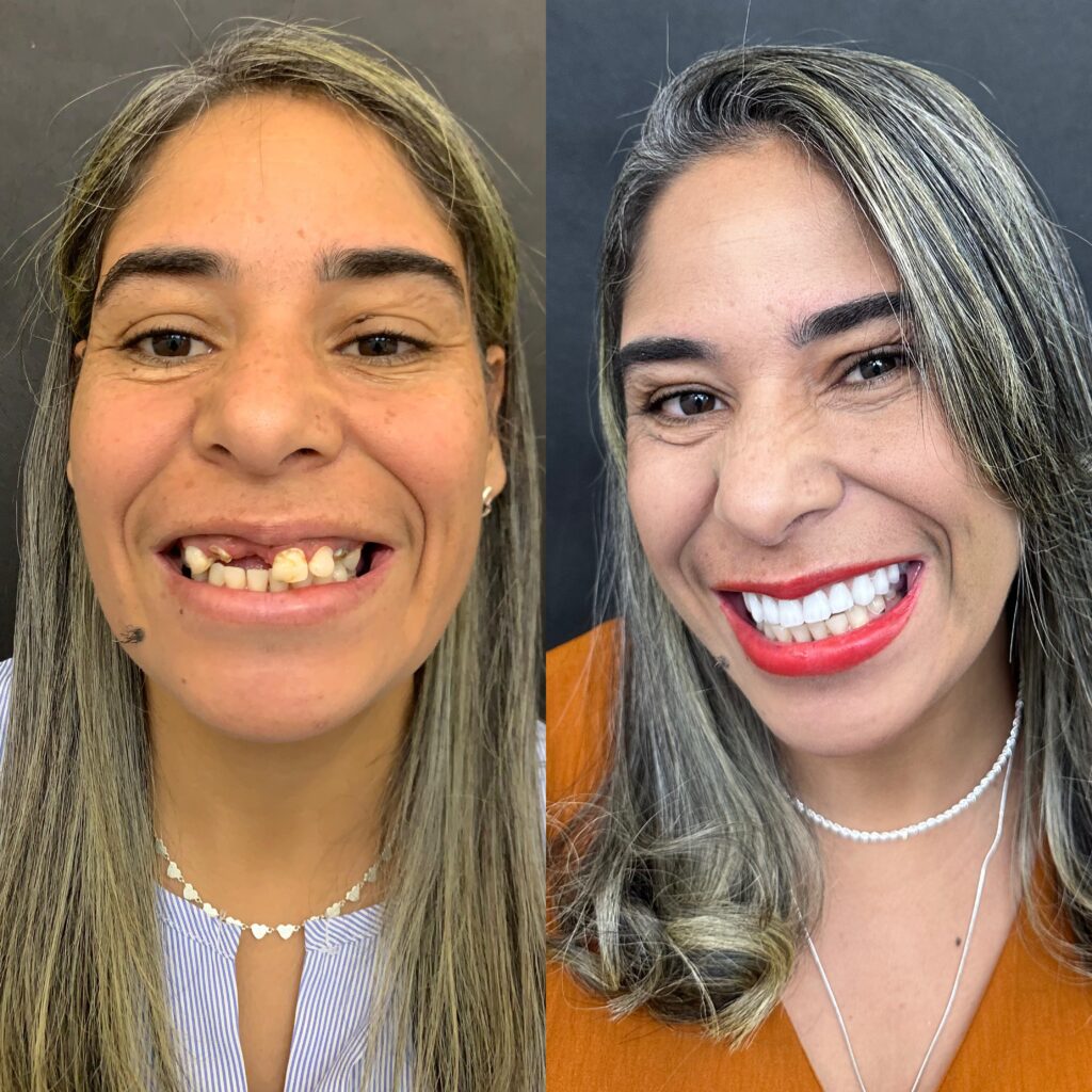 Antes e depois de paciente reabilitado com prótese protocolo sobre implantes na ImplanVita, em Belo Horizonte