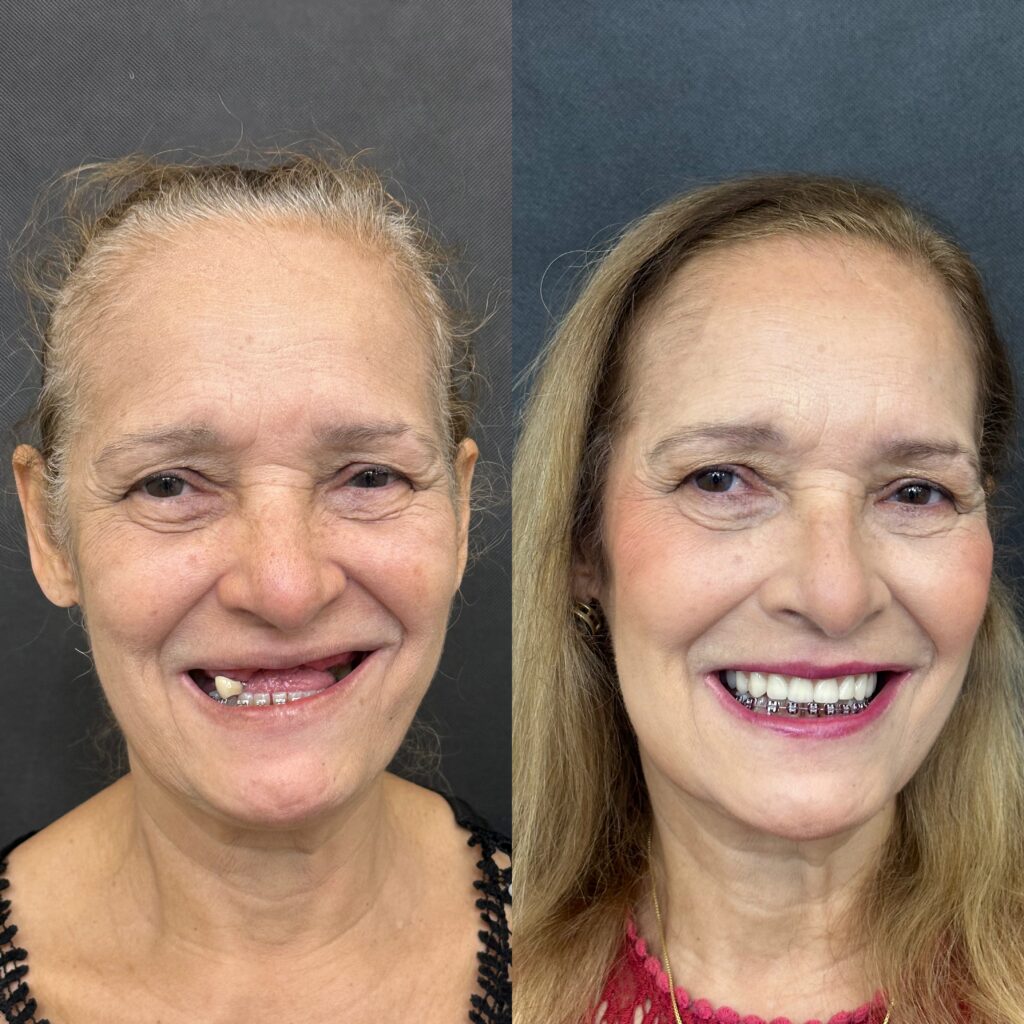 Antes e depois de paciente reabilitado com prótese protocolo sobre implantes na ImplanVita, em Belo Horizonte