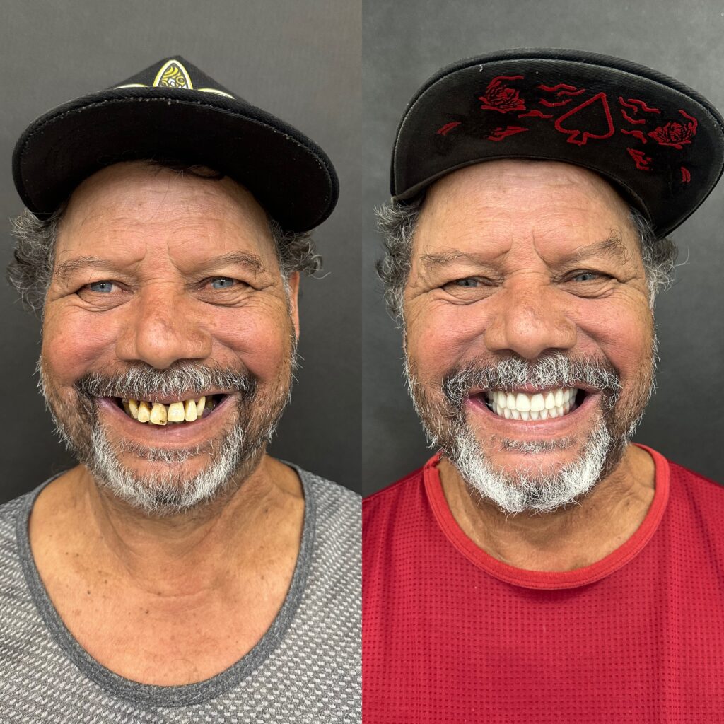 Antes e depois de paciente reabilitado com prótese protocolo sobre implantes na ImplanVita, em Belo Horizonte